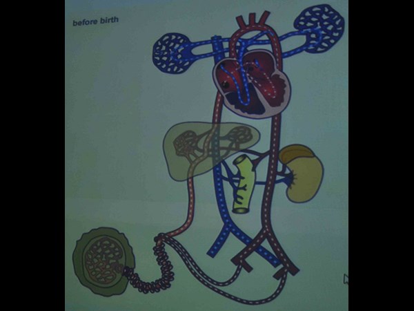 గర్భస్థ శిశువుకు సర్జరీ