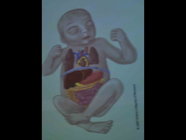 గర్భస్థ శిశువుకు సర్జరీ