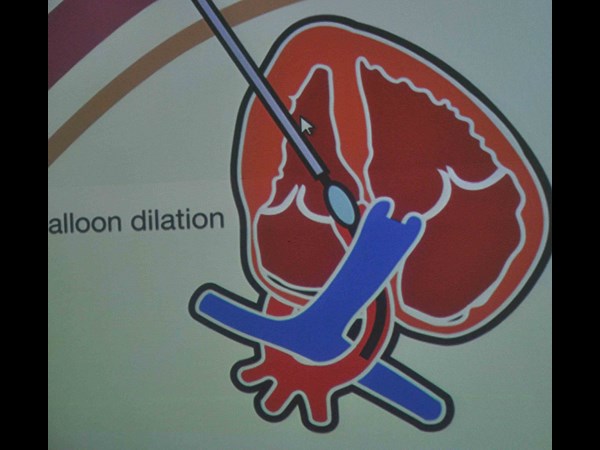 గర్భస్థ శిశువుకు సర్జరీ