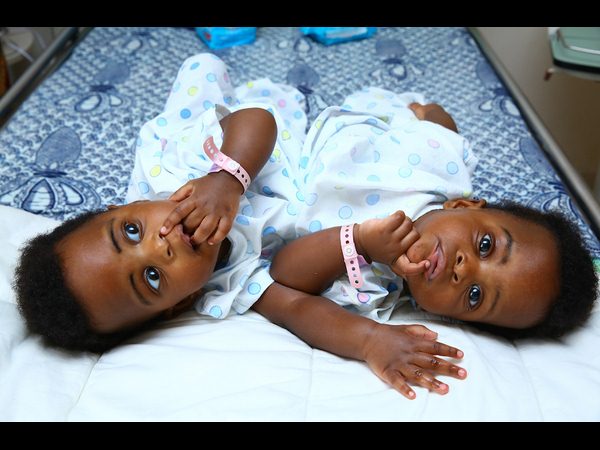  కవలలను కాపాడిన చెన్నై అపోలో