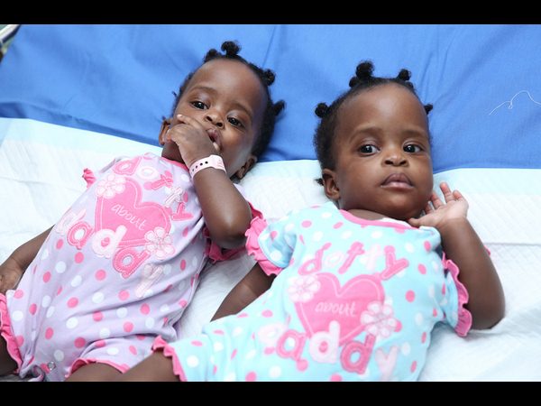 కవలలను కాపాడిన చెన్నై అపోలో