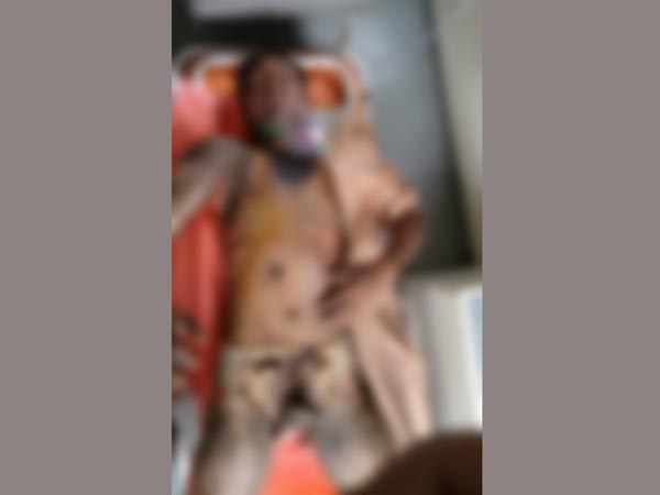 21-year-old engineering student burns himself