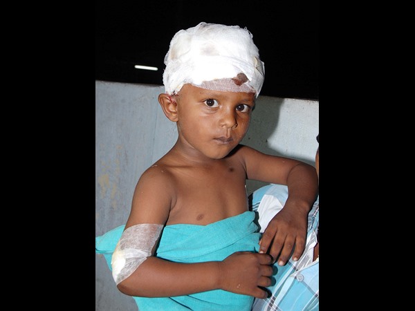 కుక్కల దాడిలో గాయపడిన చిన్నారి