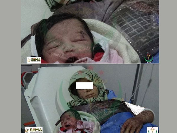 Attacked before birth: Syrian 'miracle' baby girl survives with shrapnel in head Attacked before birth: Syrian 'miracle' baby girl survives with shrapnel in head