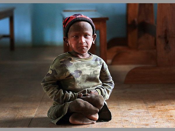  నేపాల్‌లో వింత: రాయిలా మారుతున్న బాలుడు