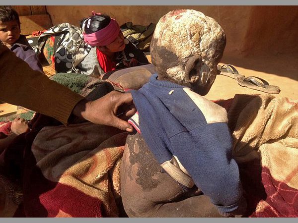  నేపాల్‌లో వింత: రాయిలా మారుతున్న బాలుడు