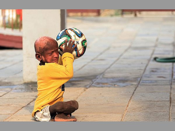 నేపాల్‌లో వింత: రాయిలా మారుతున్న బాలుడు