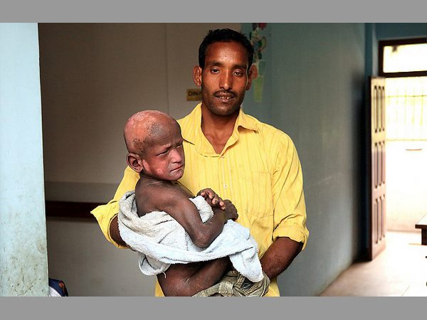  నేపాల్‌లో వింత: రాయిలా మారుతున్న బాలుడు