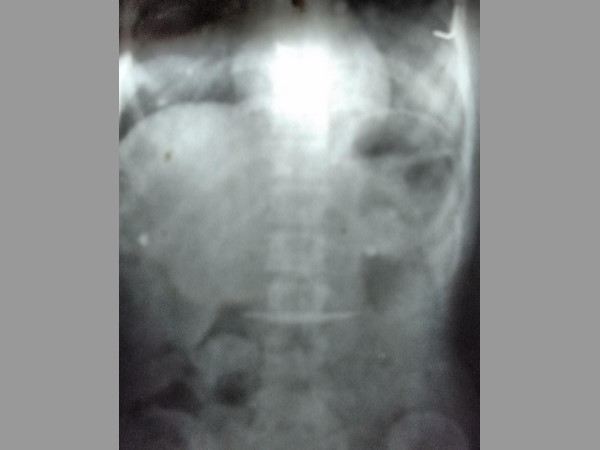 కత్తిని మింగిన మహిళ: ఆపరేషన్ చేసి బయటకు తీశారు