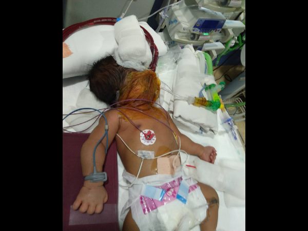 Neonatal ECMO performed at Hyderabad's KIMS Hospitals