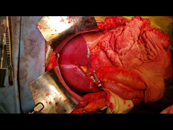  ఆదివారం ఆసుపత్రి నుంచి డిశ్చార్జి