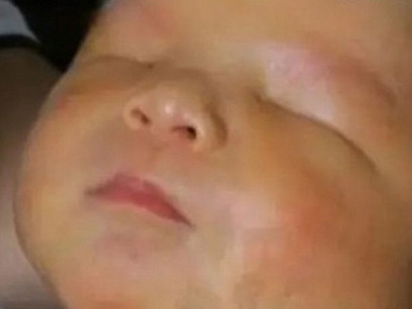 Baby Born Without Eyes Despite Mom's Normal Pregnancy