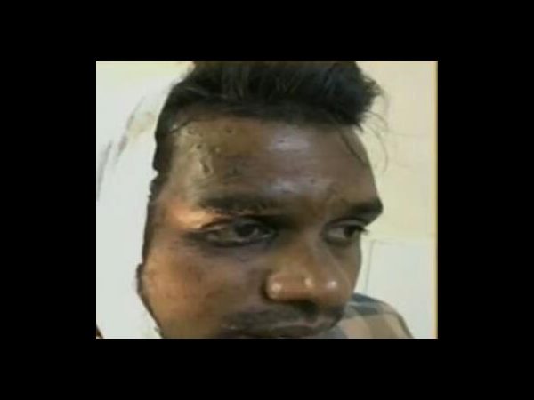 Jilted lover attacks boyfriend with acid 