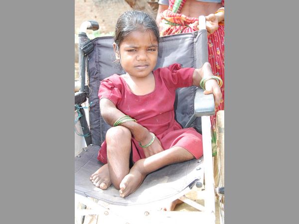 పూర్వ నల్లగొండ జిల్లాలో ఇది ఫ్లోరైడ్ తీవ్రత పూర్వ నల్లగొండ జిల్లాలో ఇది ఫ్లోరైడ్ తీవ్రత