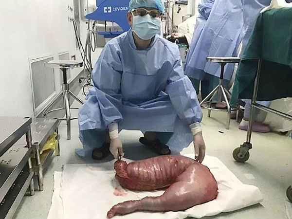 Doctors save man from deadly stomach ache by removing 13 kg feces-filled 'megacolon'