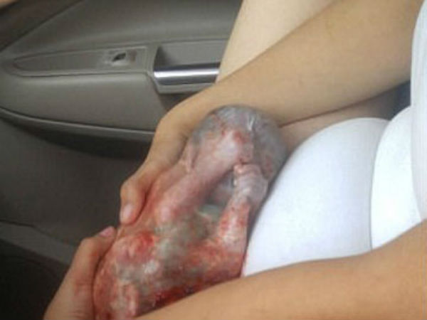 mom gives birth to premature baby still in amniotic sac