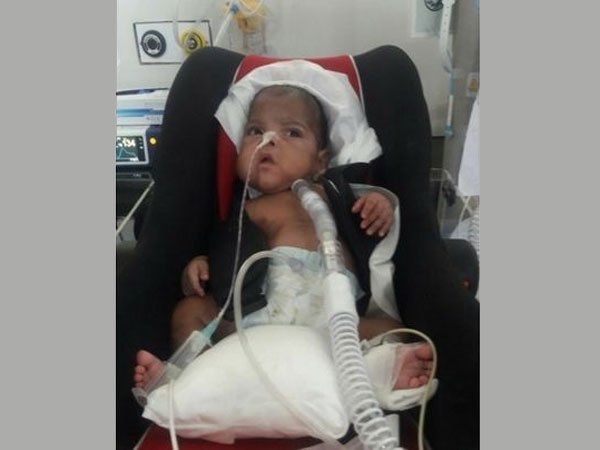 After Losing One Of Their Twins, They’re Struggling To Save The Other After Losing One Of Their Twins, They’re Struggling To Save The Other