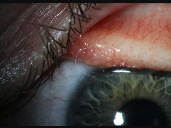  మనుషుల్లో ఏన్నడూ కానరాని ఇన్ఫెక్షన్...