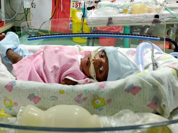 30 days girl child born prematurely and on ventilator