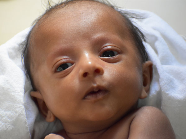 8 Month Old Anirudh Seeks Your Help For His Final Surgery