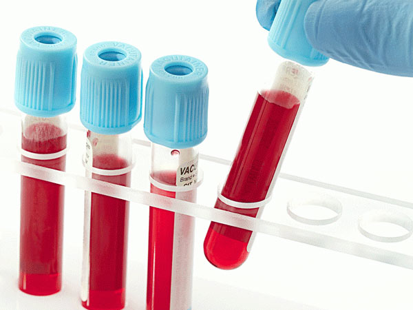 మరోసారి బ్లడ్ టెస్టు చేయించుకోగా బయటపడ్డ ఎయిడ్స్ విషయం మరోసారి బ్లడ్ టెస్టు చేయించుకోగా బయటపడ్డ ఎయిడ్స్ విషయం