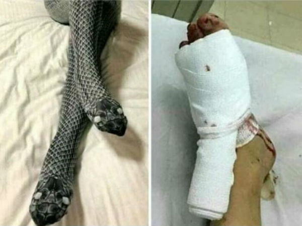 విరిగిపోయిన భార్య కాళ్లు విరిగిపోయిన భార్య కాళ్లు