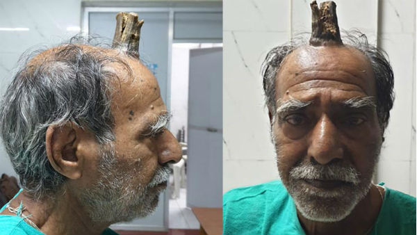 డెవిల్ హార్న్‌తో బాధపడిన శ్యాంలాల్