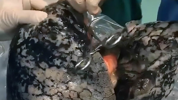 చైనాలో అవయవదానం చేసిన వ్యక్తి చైనాలో అవయవదానం చేసిన వ్యక్తి