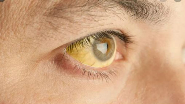 అసలేంటీ ఎల్లో ఫీవర్ కథ...