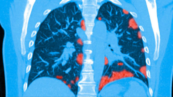  6వారాలకు 12 వారాలకు తీసిన సీటీ స్కాన్ రిపోర్టు