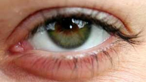 మ్యూకర్మైకోసిస్ కట్టడి ఎలా? మ్యూకర్మైకోసిస్ కట్టడి ఎలా?