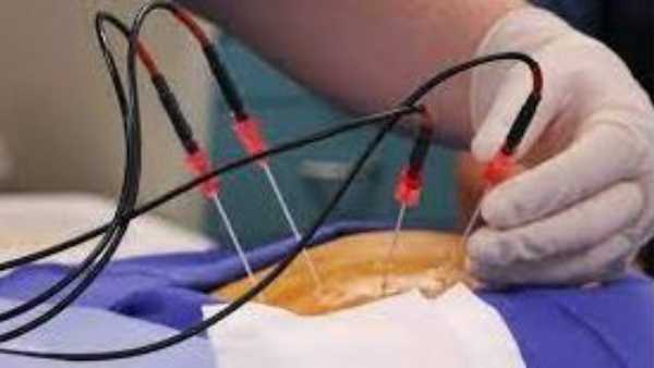 RFA procedure at Yashoda Hospitals helps Weightlifter Halavath Karthik recover back pain