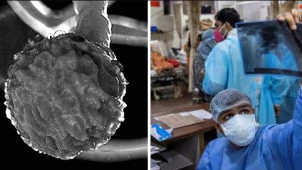 బ్లాక్ ఫంగస్ కాటేస్తే తీవ్ర పరిణామాలు
