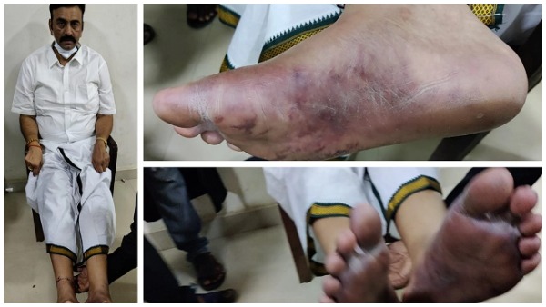 షుగర్ వల్లే కాళ్లు అలా.. సోషల్ మీడియాలో ప్రచారం...