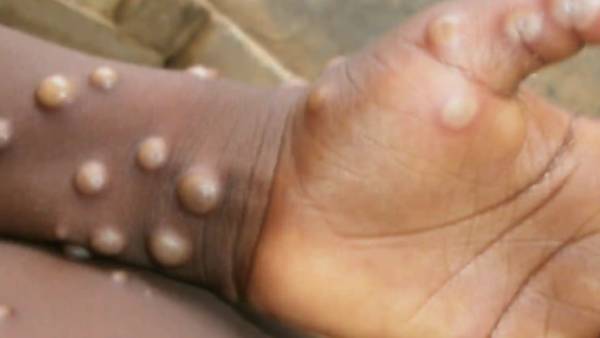 మందులు లేవు .. శరీరం కోల్పోయే నీటిని ద్రవాలను తీసుకోని కాపాడుకోవటమే మార్గం