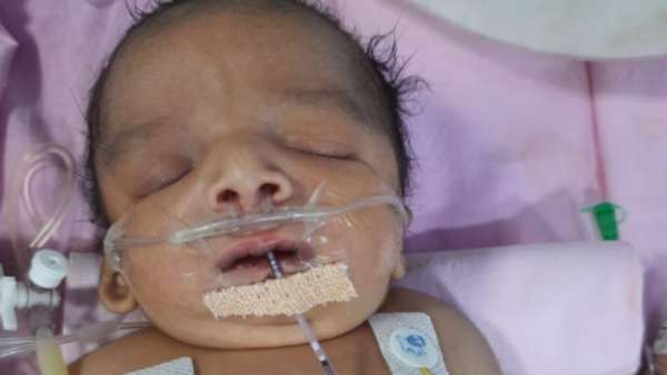 Help 6 months old boy affected with Treacher collins syndrome