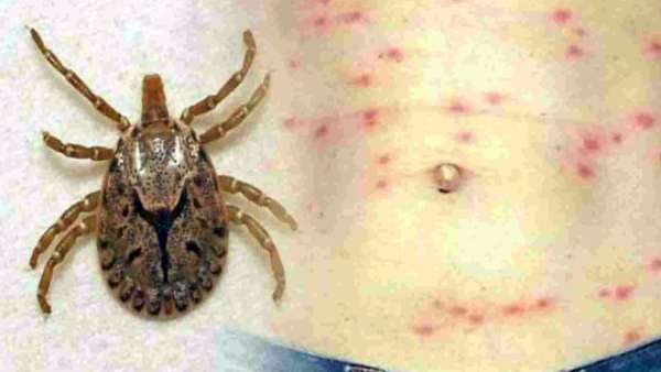  దేశంలోనూ స్క్రబ్ టైఫస్ కేసులు