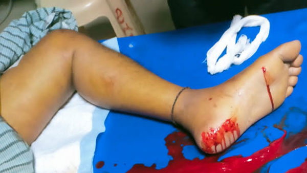 ఎంజీఎం ఆస్పత్రిలో రోగి కాలి వేళ్ళు, చేతుల వేళ్ళు కొరికిన ఎలుకలు