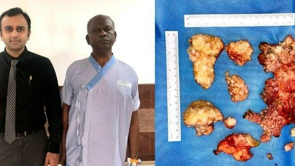 మోకాలి నొప్పితో ఆస్పత్రికి వెళ్ళిన కార్మికుడికి అరుదైన చికిత్స 