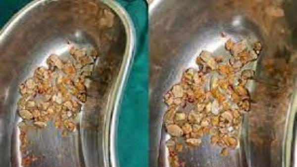 206 రాళ్లు