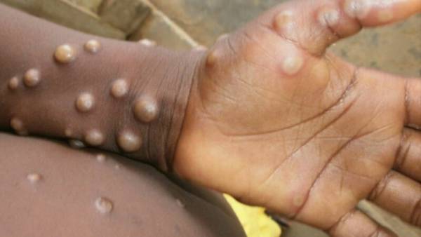 మంకీపాక్స్ వ్యాధి లక్షణాలు, వ్యాప్తి గురించి..