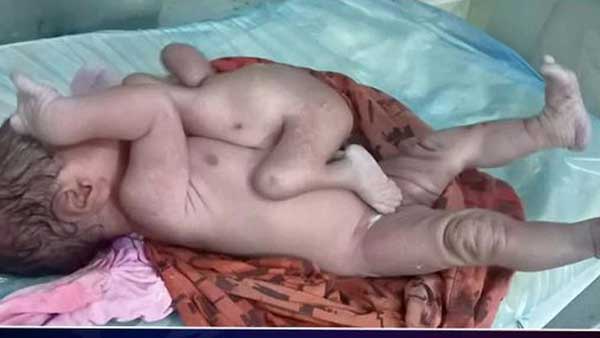 యూపీలో వింత శిశువు జననం