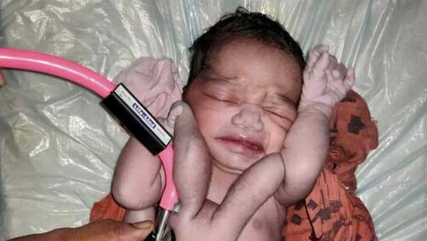 కవలపిల్లలు పుట్టాల్సి ఉన్నా ఒక శిశువు ఎదగకపోవటంతోనే ఇలా