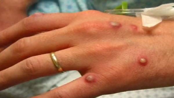 India reports Ninth monkeypox case as Nigerian woman tests positive in Delhi India reports Ninth monkeypox case as Nigerian woman tests positive in Delhi