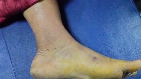 పాముకాటు వ్యవహారం బయటకు రాకుండా జాగ్రత్త పడిన యూనివర్సిటీ అధికారులు 