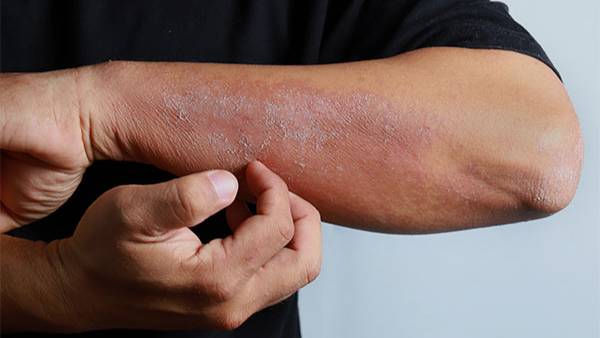 కర్కుమిన్