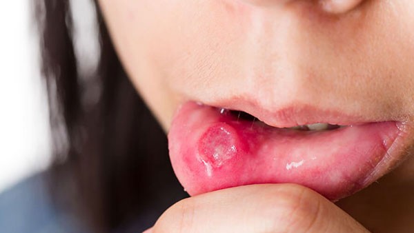 నోటిపూత రావటానికి కారణాలివే నోటిపూత రావటానికి కారణాలివే