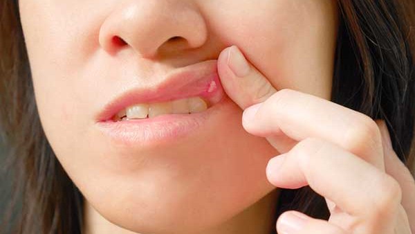 నోటిపూతకు ఈ ఆహారాలు తినండి నోటిపూతకు ఈ ఆహారాలు తినండి