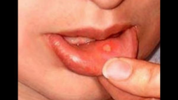 నోటిపూతకు చాలా నేచురల్ రెమిడీస్ నోటిపూతకు చాలా నేచురల్ రెమిడీస్