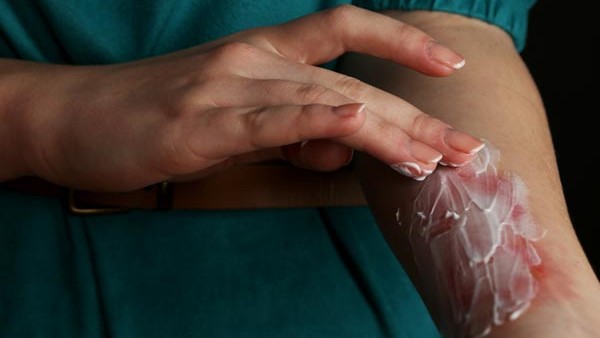 కాలిన గాయాలు